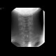 Foreign body in the oesophagus: RF - Fluoroscopy